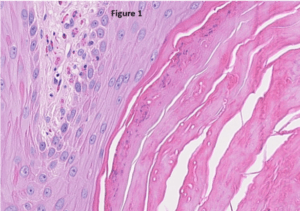 Microscopic view of pink colored tissue with hyperkeratosis and mixed leukocytic infiltrates in the upper dermis of a bearded dragon
