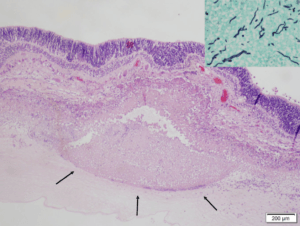 Microscopic view of pink and purple colored tissue of a German Shepherd's detached retina with inflammatory exudate and intralesional fungi on the inner surface (arrows).