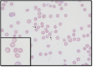 Blood smear examined under microscope showing anemia, thrombocytopenia, and numerous small Babesia gibsoni organisms. Blood from dog.