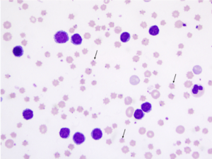 Microscopic image of blood smear depicting the presence of bovine leukemia virus.