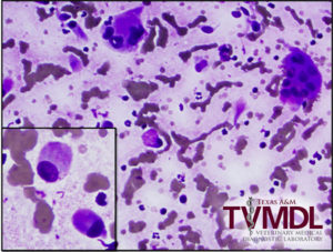 Osteoblasts and osteoclasts from an impression smear of an osteosarcoma.