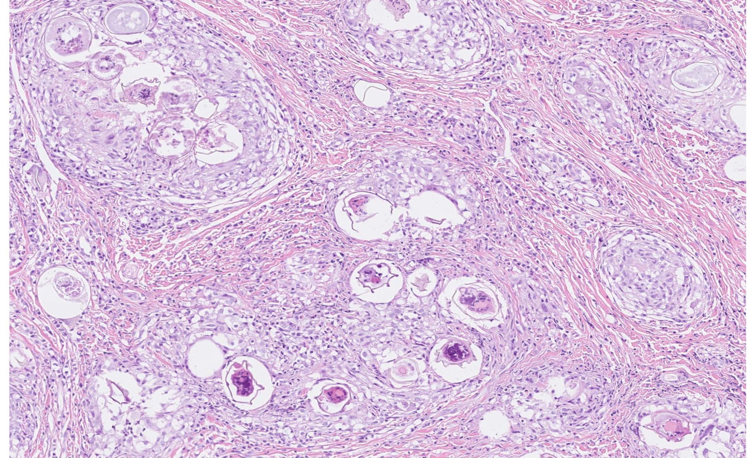 Photomicrograph of numerous trematode ova surrounded by granulomatous inflammation and fibrous connective tissue.