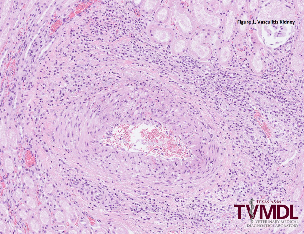 Figure 1. Photomicrograph depicting vasculitis in the kidney.