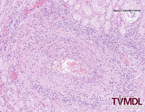 Figure 1. Photomicrograph depicting vasculitis in the kidney.